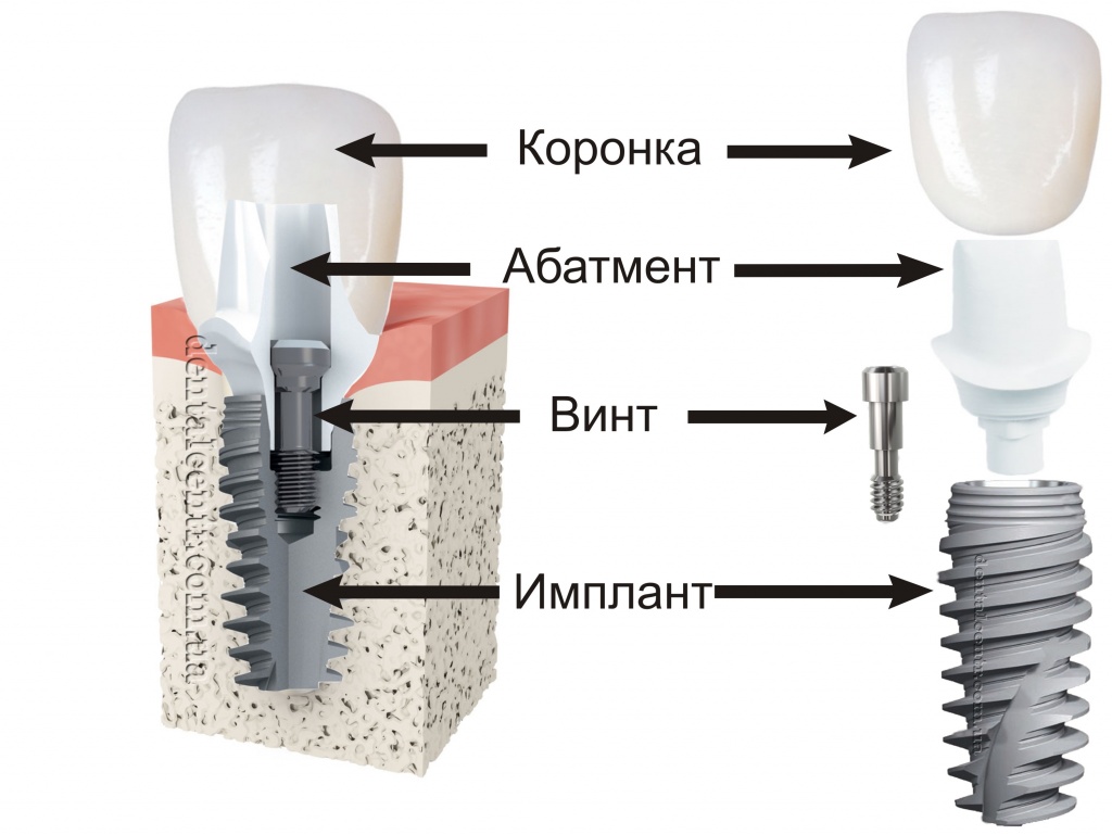 имплант.jpg имплант.jpg